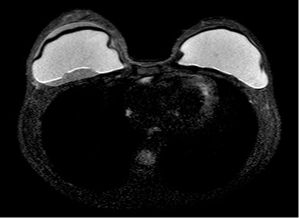 МРТ молочных желез: исследование имплантов