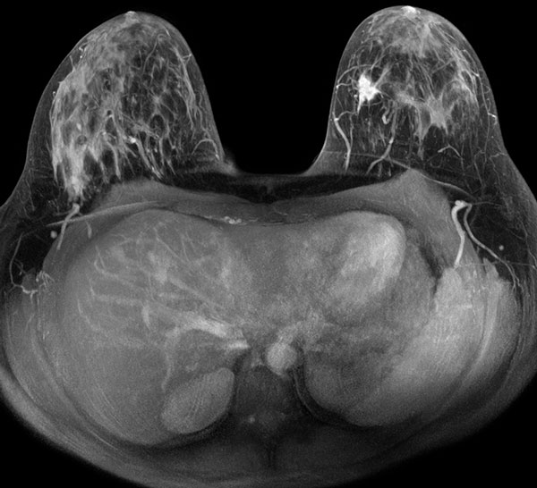 МРТ молочных желез: рак левой молочной железы