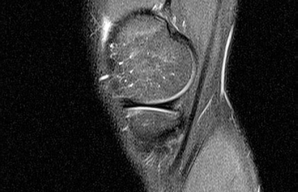МРТ коленного сустава в норме