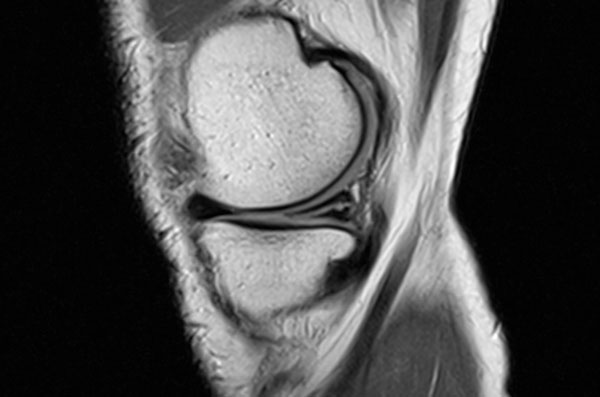МРТ - разрыв медиального мениска