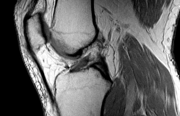 МРТ - разрыв передней крестовидной связки