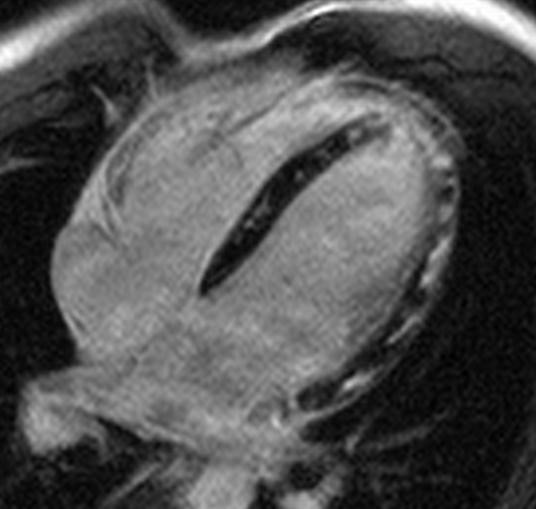 МРТ. Четырехкамерное сечение сердца. Миокардит, субэпикардиальное и интрамиокардиальное накопление контрастного препарата