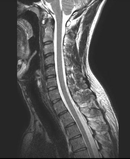 МРТ шейного отдела позвоночника