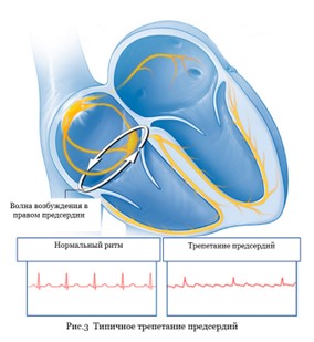 типичное трепетание предсердий